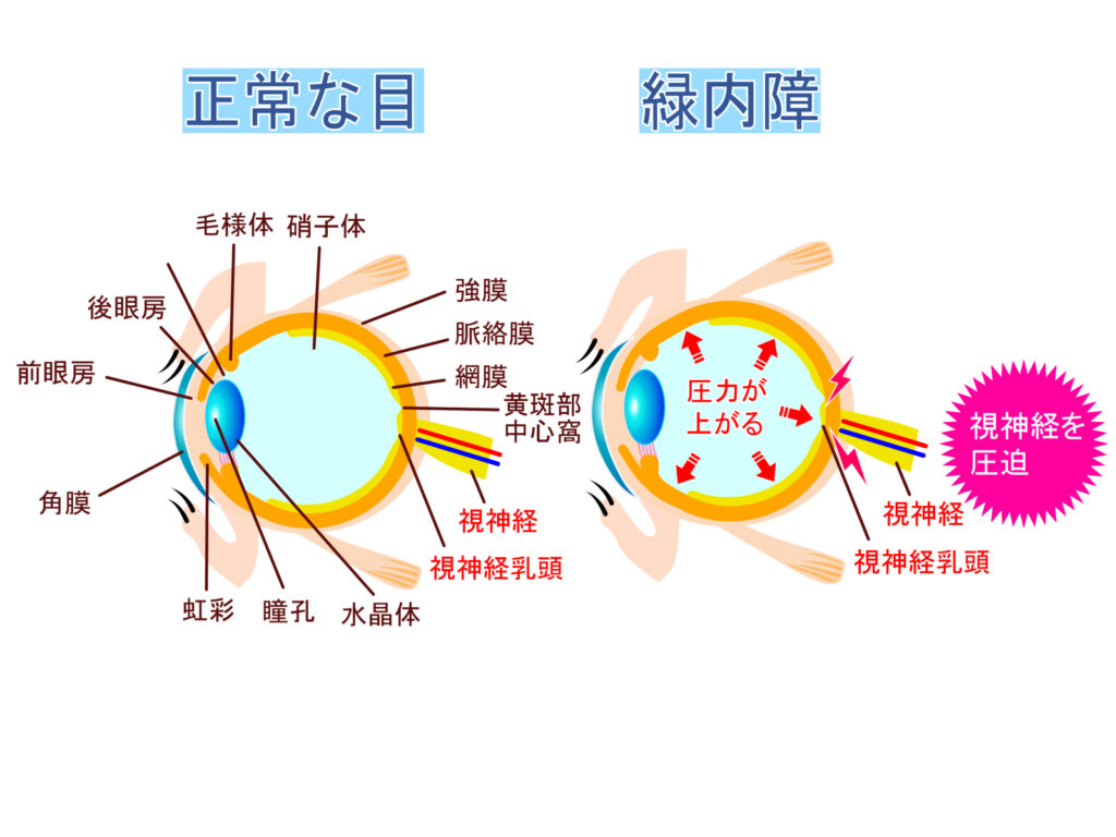 緑内障のイメージとして