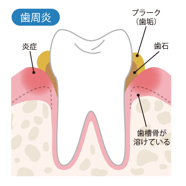 歯石と炎症のイメージとしての歯周炎