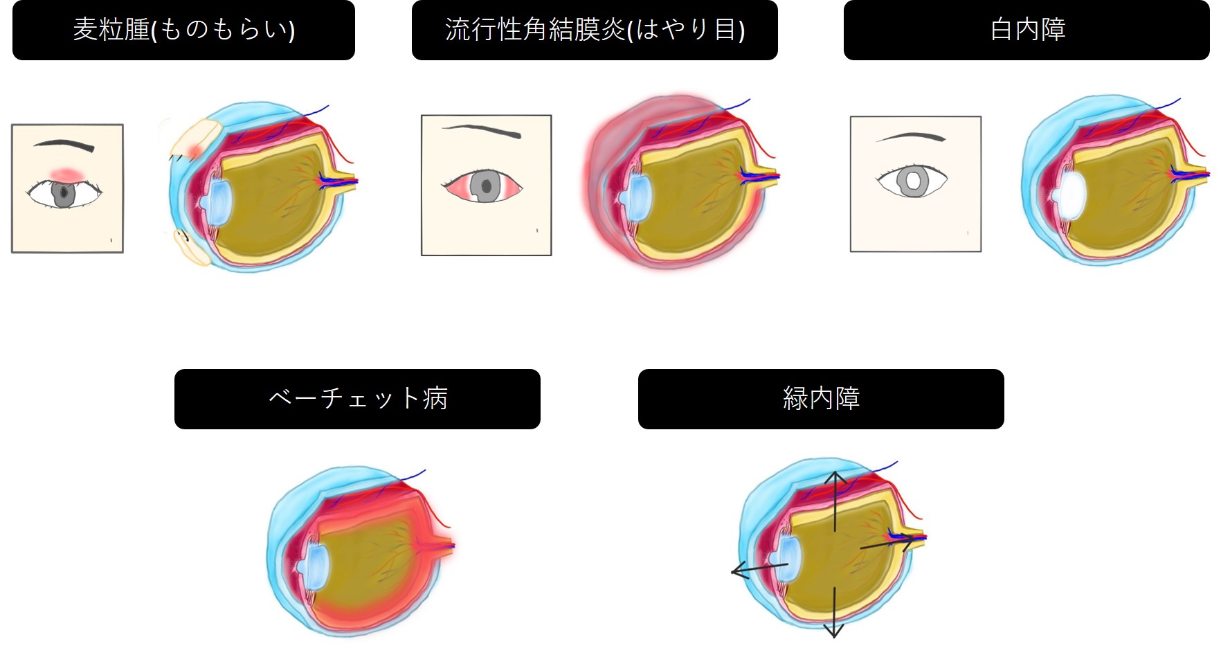 登録販売者試験 独学ブログ | 269|口内炎用薬 ⑴ 口内炎・舌炎|要因|相互作用|受診勧奨